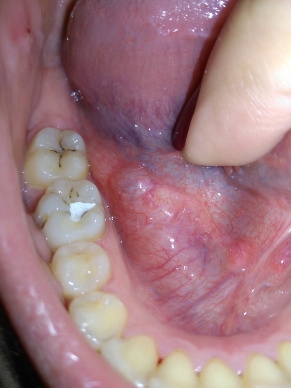 oslozhneniya papilloma yazika eto otlichnaya fraza pridetsya Папиллома языка это осложнения фото