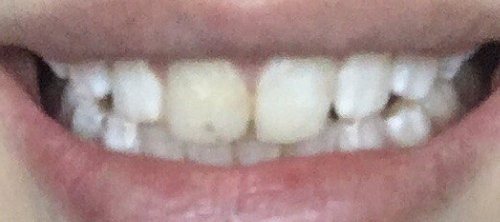 Потемнел нарощенный зуб