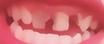 Ужасное состояние зубов лечение