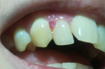 Болит уздечка за передними зубами
