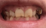 Очень плохие зубы после лечения