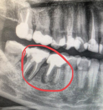 Болит между 6 и 7 зубами