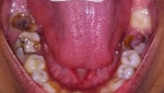 Лечение зубов очень запущенных thumbnail