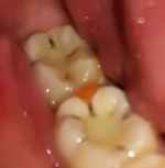 Болит между 6 и 7 зубами