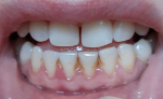 Болит уздечка между зубами