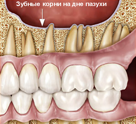 Корни зубов у дна верхнечелюстной пазухи