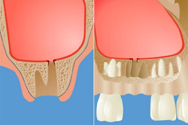 Перфорация дна гайморовой пазухи после удаления зуба