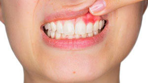 Сколько болит десна после имплантации зуба thumbnail