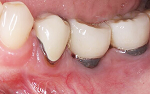 Почему болит зуб рядом с имплантом thumbnail