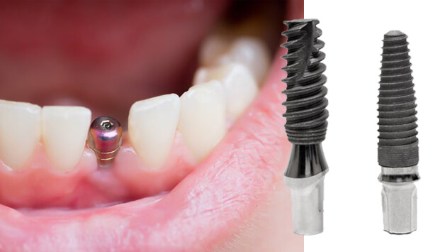 Имплантация зубов дорогостоящее лечение или нет thumbnail