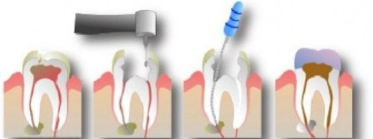 Маленький кариес зубов лечение thumbnail