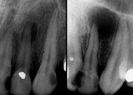 Может ли образоваться киста после лечения зуба thumbnail