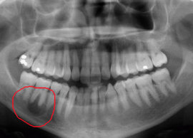 Гнойное воспаление кисты зуба лечение thumbnail