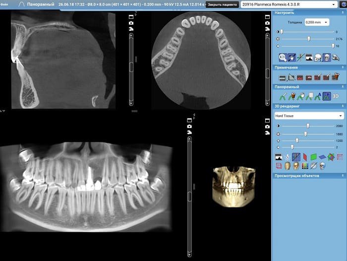 Имплант можно ли делать мрт. Можно ли делать кт с имплантом. Можно ли делать кт с имплантом. Можно ли делать кт с имплантом. Мрт с имплантами зубов.