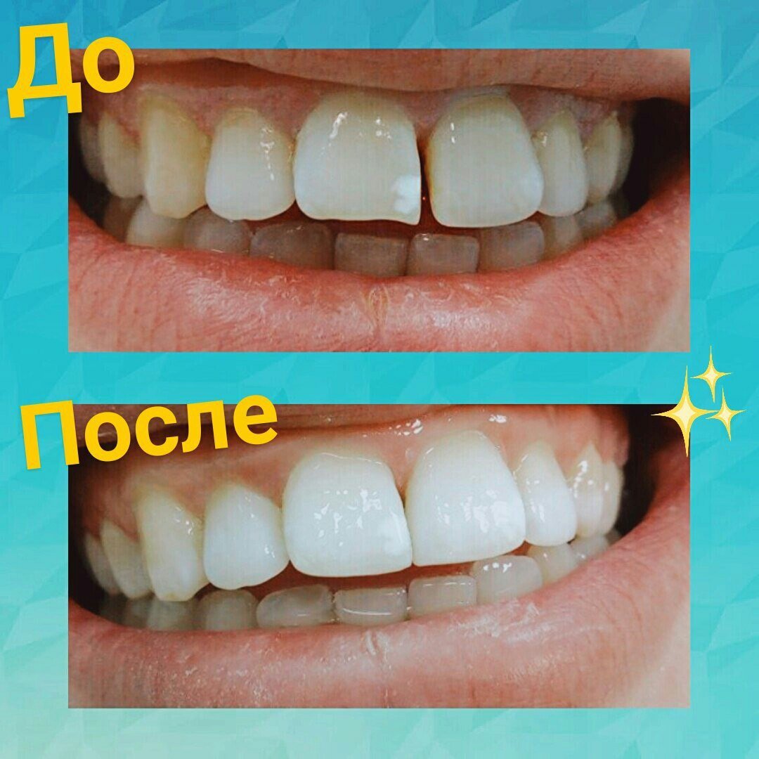 а2 и а1 цвет зубов фото цирконий