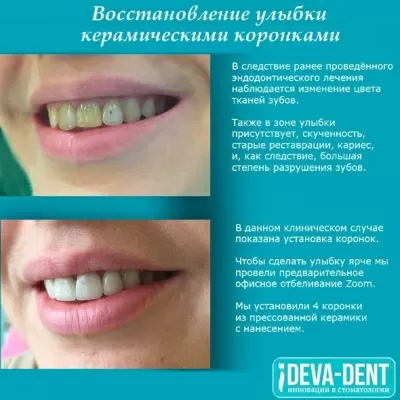 Deva-Dent