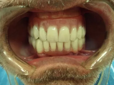 Стеллс-Стом