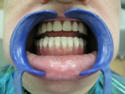 Стеллс-Стом