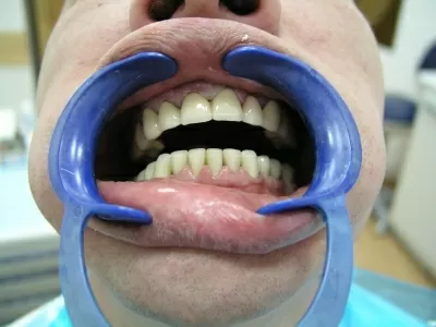 Стеллс-Стом