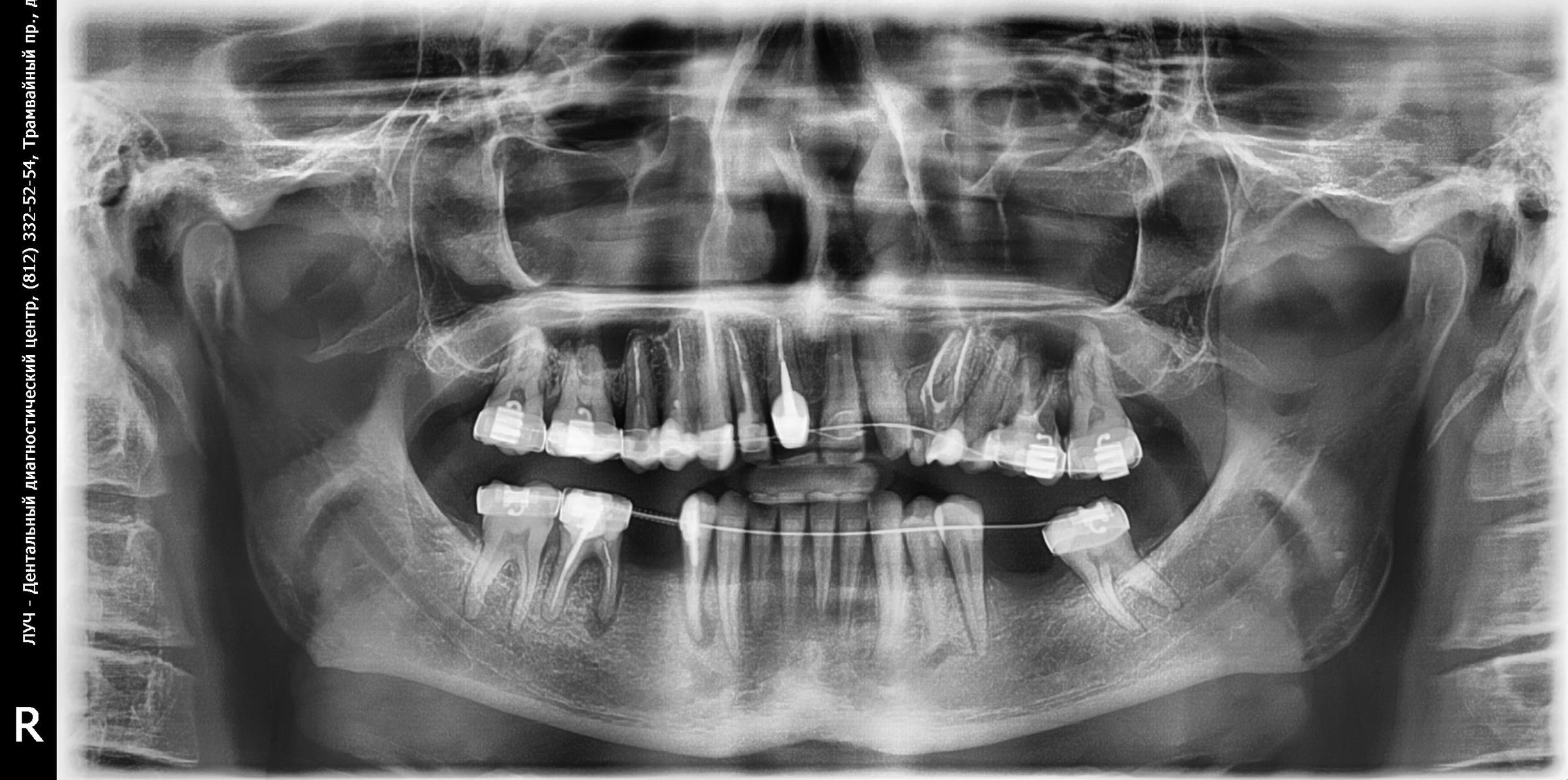 Панорамный снимок. Ортопантомограмма ВНЧС. Ортопантомограмма (ОПТГ) 900. Панорамный снимок ВНЧС.