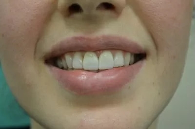 Ультрадент