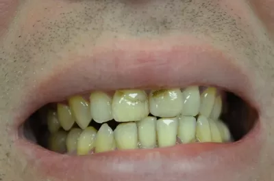 Ультрадент