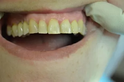 Ультрадент