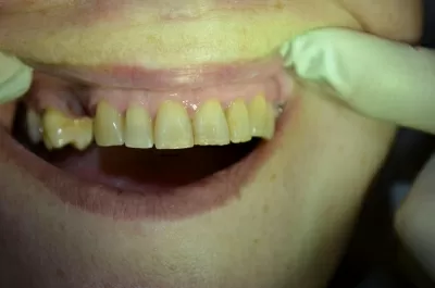 Ультрадент