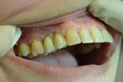 Ультрадент