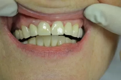 Ультрадент