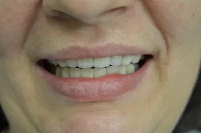 Ультрадент