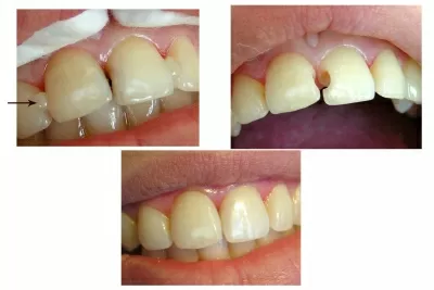 Корона дентис