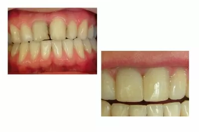 Корона дентис