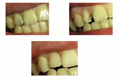 Корона дентис