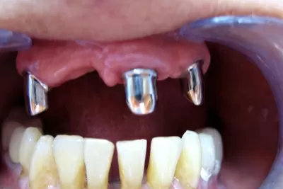 Корона дентис