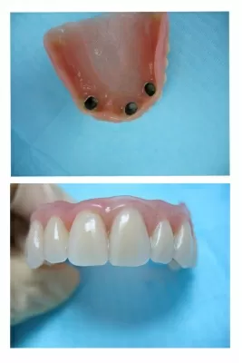 Корона дентис