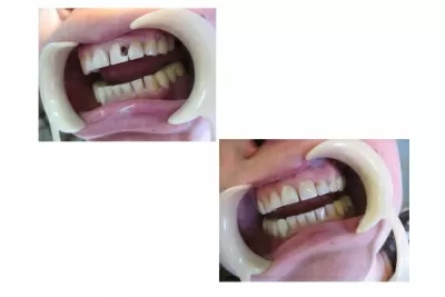 Корона дентис