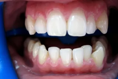 Корона дентис