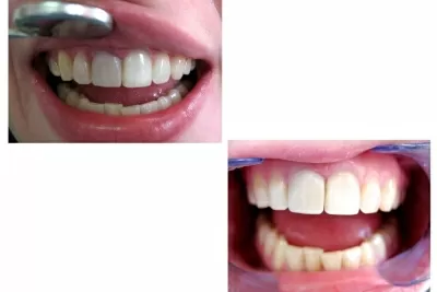 Корона дентис