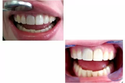 Корона дентис