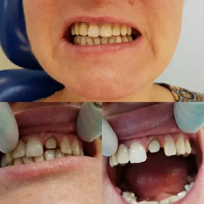 Катран Дент