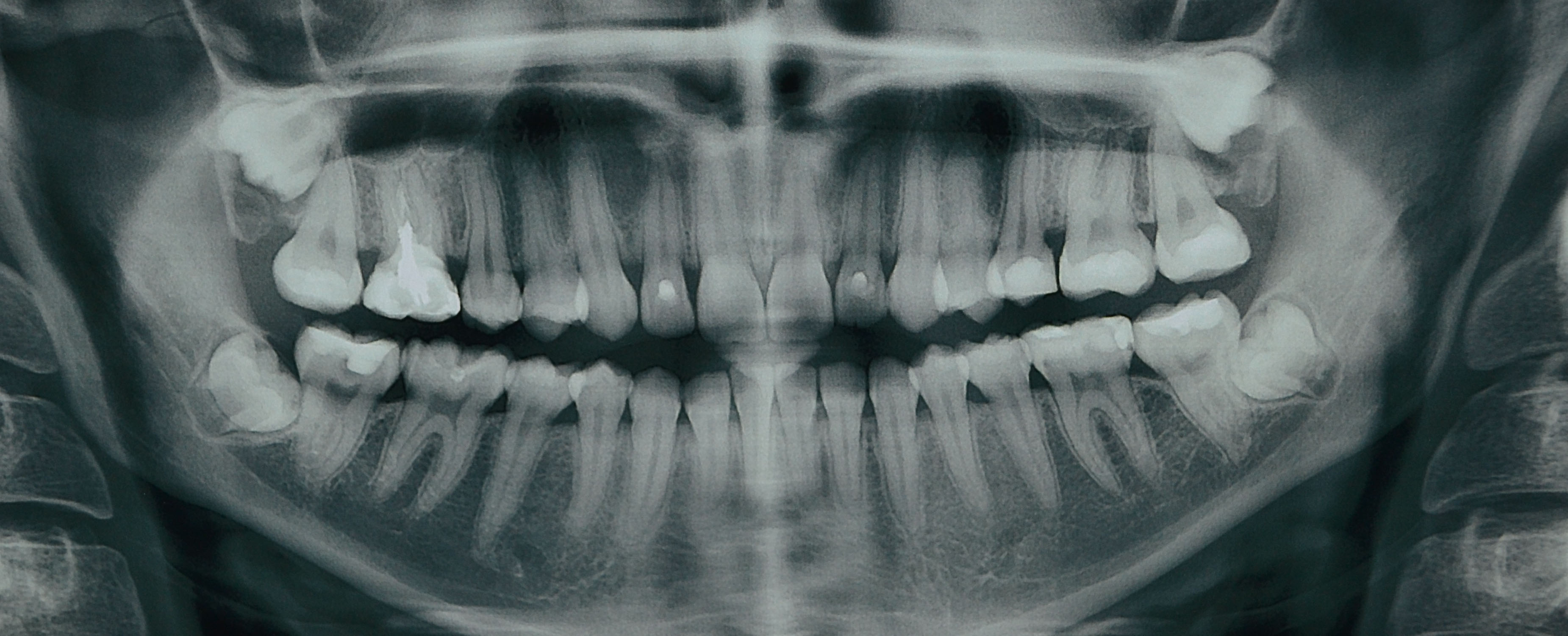 фото восьмерок зубов