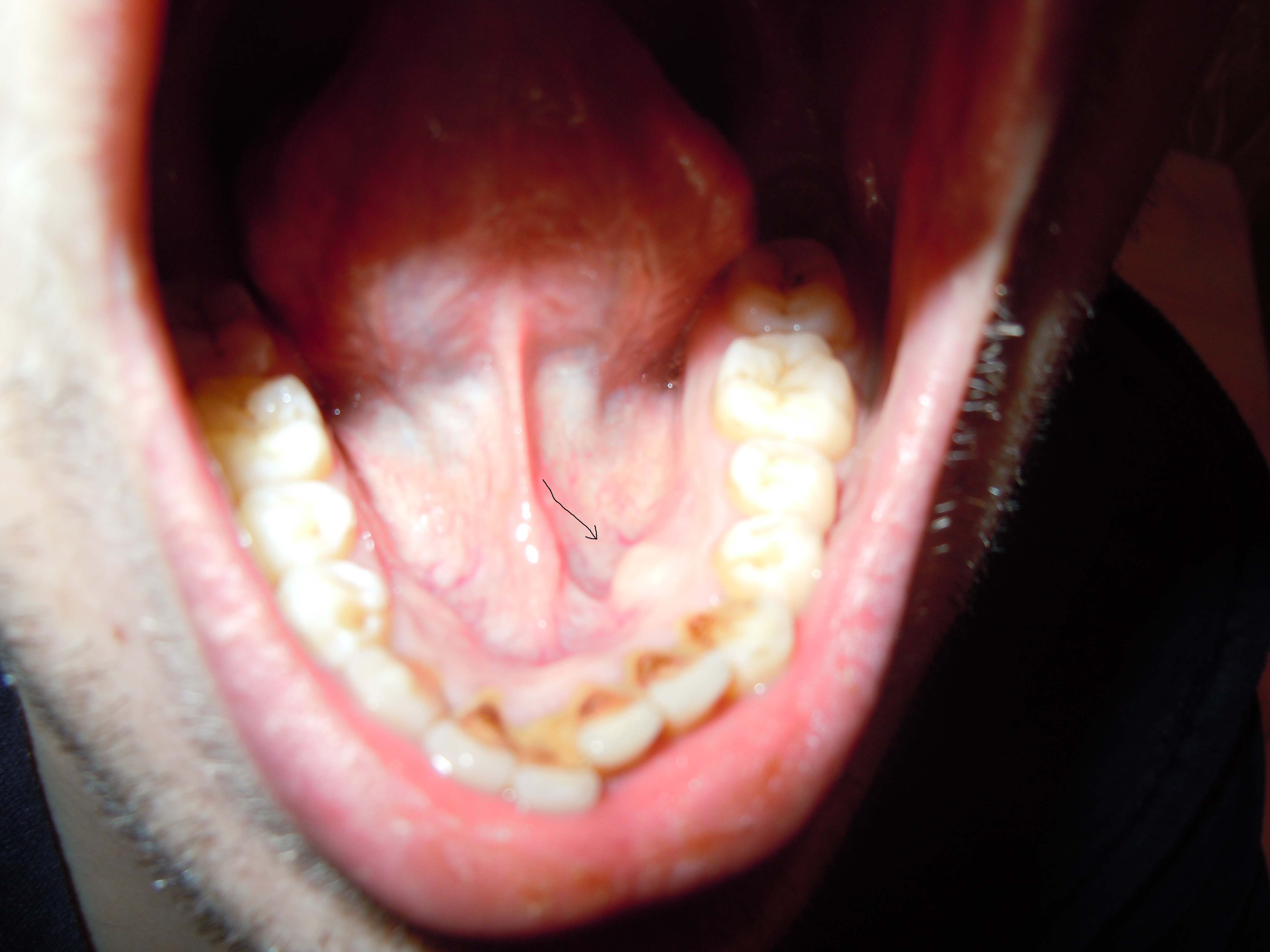 Ретенционная киста нижней губы