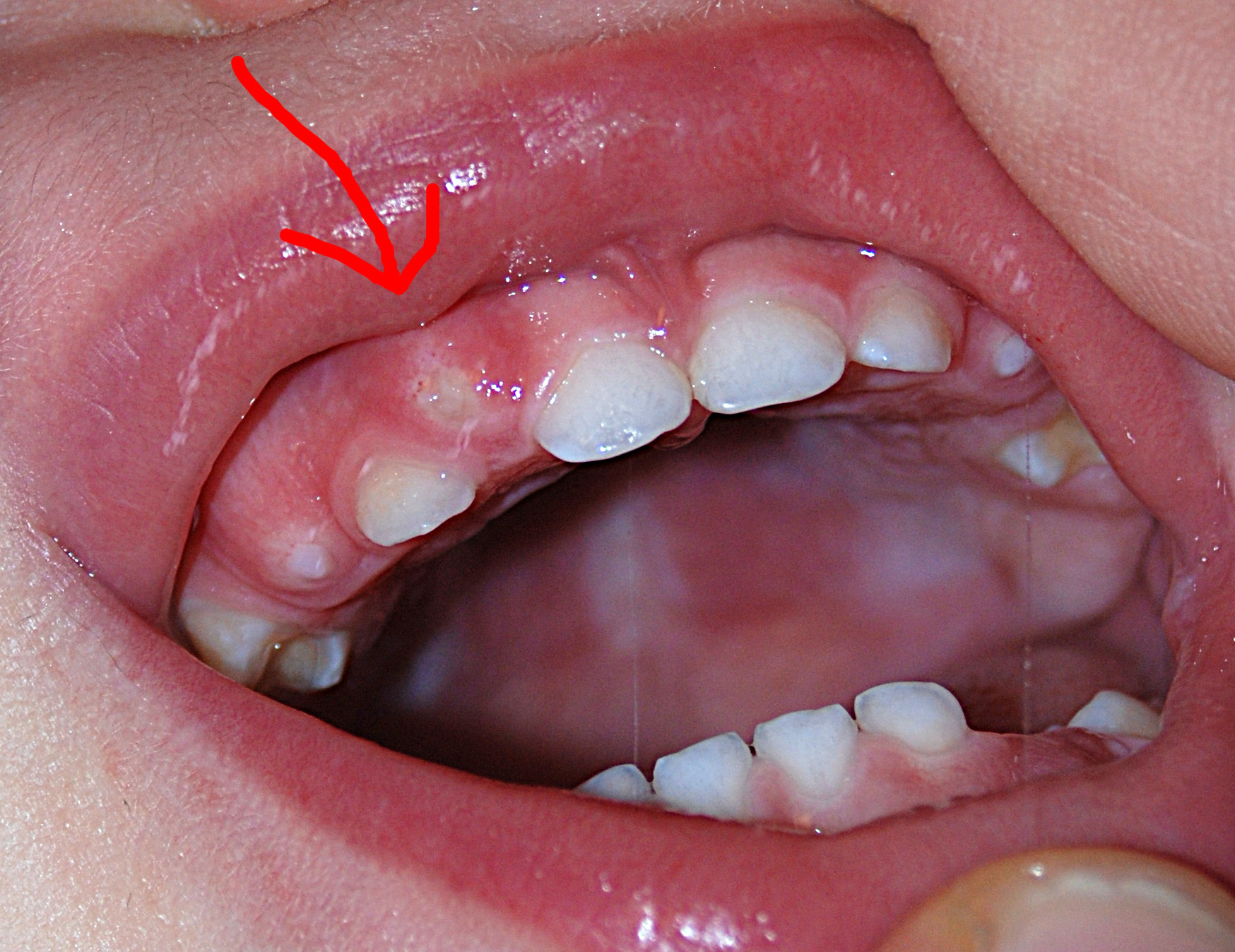 У ребенка растет зуб на десне: что делать и как исправить?
