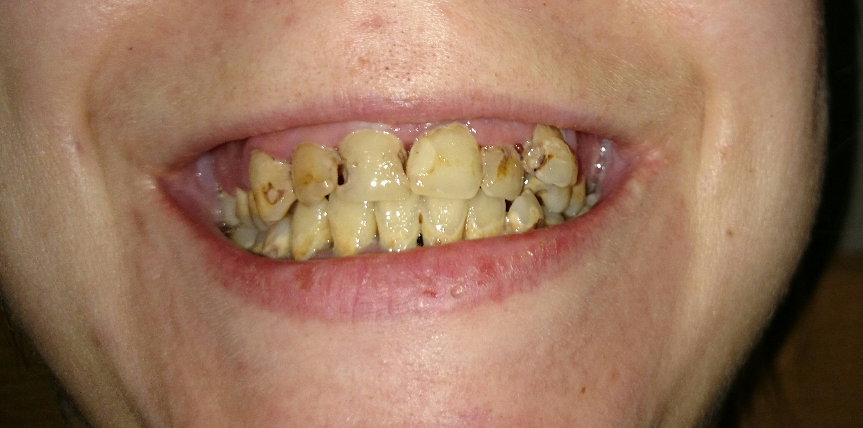 Внутренние причины крошения зубов