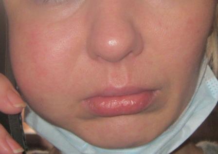 Опухла щека: причины, первая помощь и методы лечения