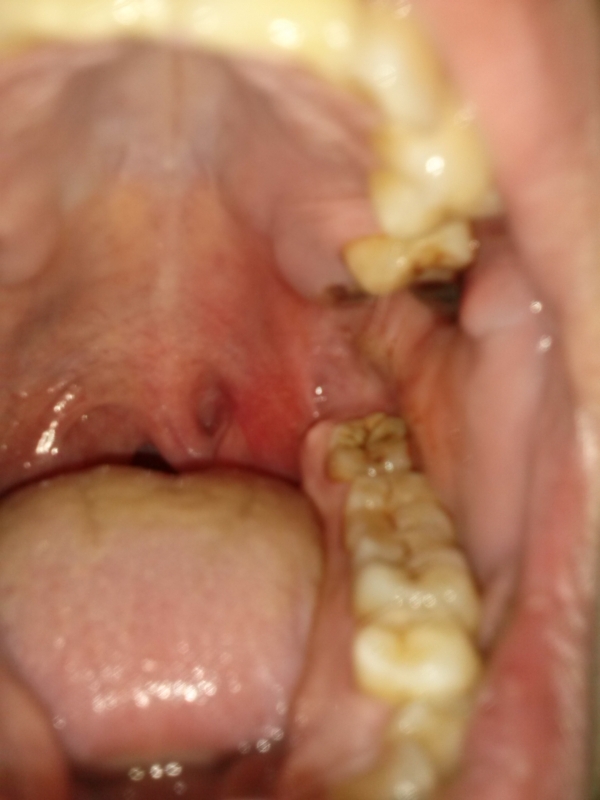 Заживление лунки зуба после удаления — Сеть МЦ «Доктор Боголюбов»