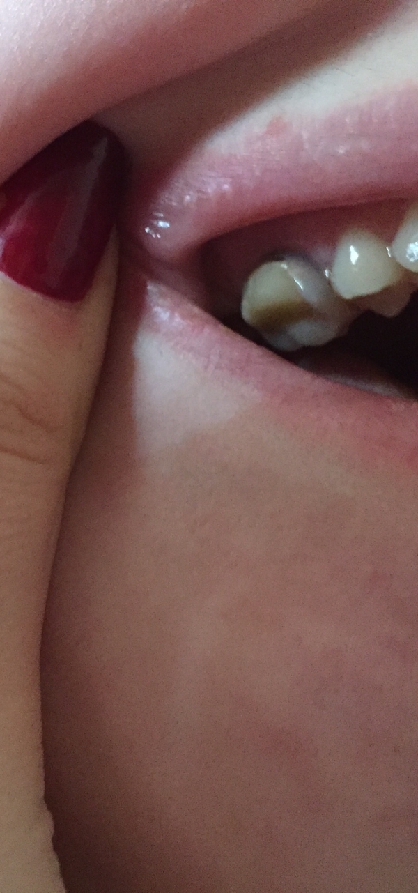 Зуб потемнел после лечения, почему?
