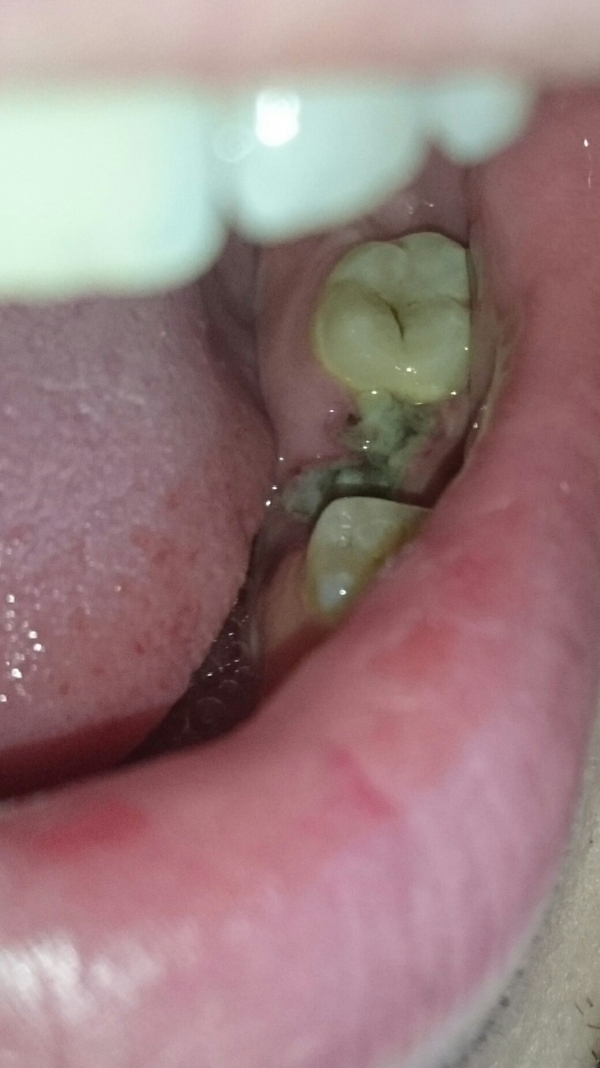 Рекомендации после удаления зуба и других операций в полости рта