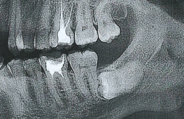Зуб 8 корень. Ретинированный зуб рентген. Ретинированный зуб мудрости рентген.